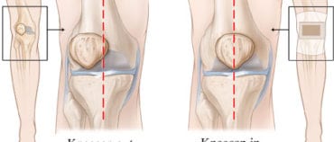 A Simple, Easy and Fast Technique To Reduce Frustrating Knee Pain By About 50% Within 5 Minutes