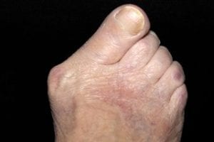 Foot Pain Causes Bunion